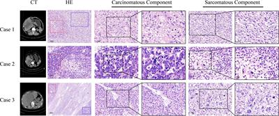 Case report: ZEB1 expression in three cases of hepatic carcinosarcoma